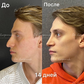 До и после ринопластики. Хирург Сергей Карпович
