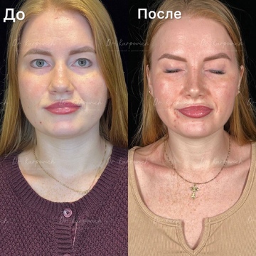 До и после. Ринопластика / риносептопластика. Доктор Сергей Карпович