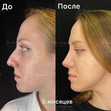 До и после ринопластики. Хирург Сергей Карпович