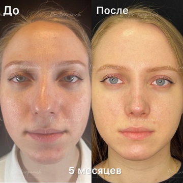 До и после. Ринопластика / риносептопластика. Доктор Сергей Карпович