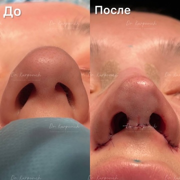 До и после. Ринопластика / риносептопластика. Доктор Сергей Карпович