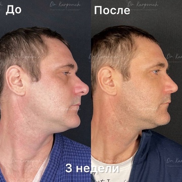 До и после ринопластики. Хирург Сергей Карпович