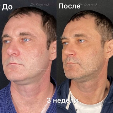 До и после. Ринопластика / риносептопластика. Доктор Сергей Карпович