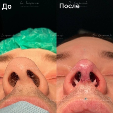 До и после. Ринопластика / риносептопластика. Доктор Сергей Карпович