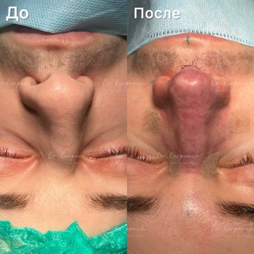 До и после. Ринопластика / риносептопластика. Доктор Сергей Карпович