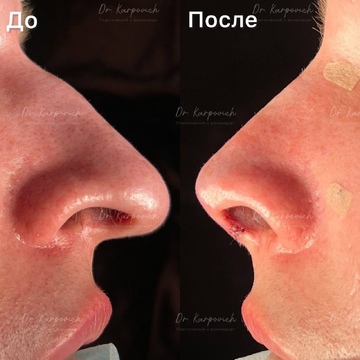 До и после ринопластики. Хирург Сергей Карпович