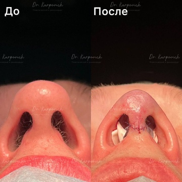 До и после. Ринопластика / риносептопластика. Доктор Сергей Карпович
