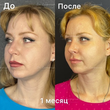 До и после ринопластики. Хирург Сергей Карпович