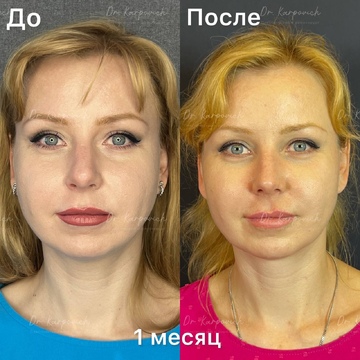 До и после. Ринопластика / риносептопластика. Доктор Сергей Карпович