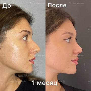 До и после ринопластики. Хирург Сергей Карпович