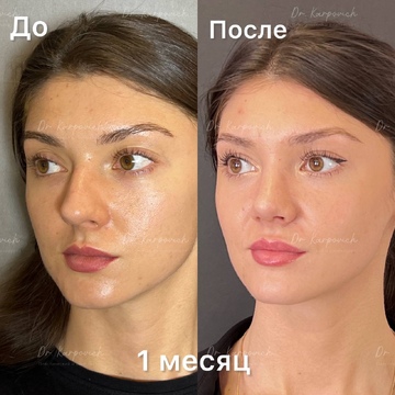 До и после. Ринопластика / риносептопластика. Доктор Сергей Карпович