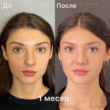 До и после. Ринопластика / риносептопластика. Доктор Сергей Карпович