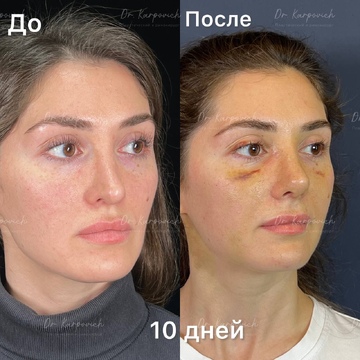 До и после. Ринопластика / риносептопластика. Доктор Сергей Карпович