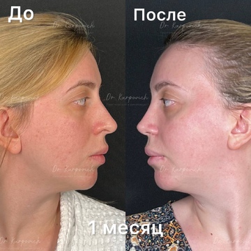До и после ринопластики. Хирург Сергей Карпович