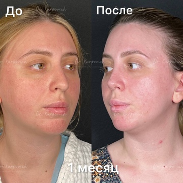 До и после. Ринопластика / риносептопластика. Доктор Сергей Карпович