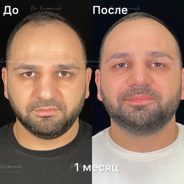 До и после. Ринопластика / риносептопластика. Доктор Сергей Карпович