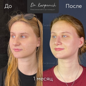 До и после ринопластики. Хирург Сергей Карпович