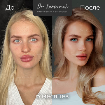 До и после ринопластики. Хирург Сергей Карпович