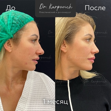 До и после ринопластики. Хирург Сергей Карпович