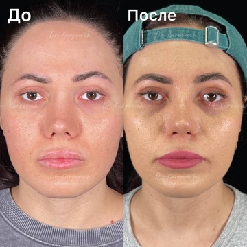 До и после. Ринопластика / риносептопластика. Доктор Сергей Карпович