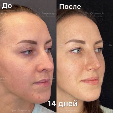 До и после ринопластики. Хирург Сергей Карпович