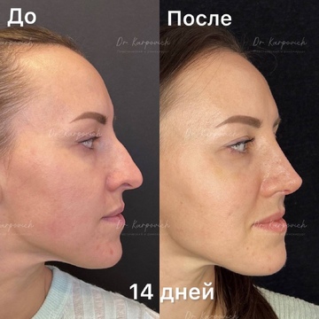До и после. Ринопластика / риносептопластика. Доктор Сергей Карпович
