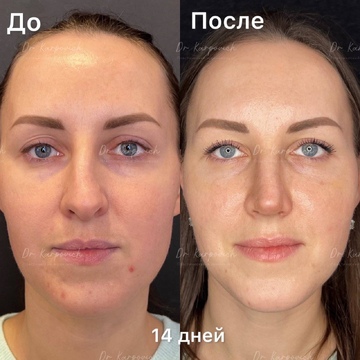 До и после. Ринопластика / риносептопластика. Доктор Сергей Карпович