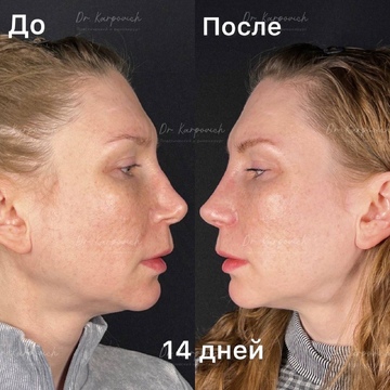 До и после ринопластики. Хирург Сергей Карпович