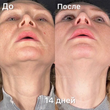 До и после. Ринопластика / риносептопластика. Доктор Сергей Карпович