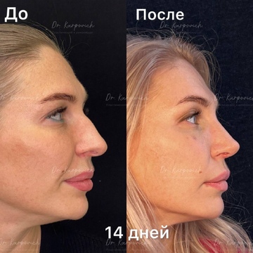 До и после ринопластики. Хирург Сергей Карпович