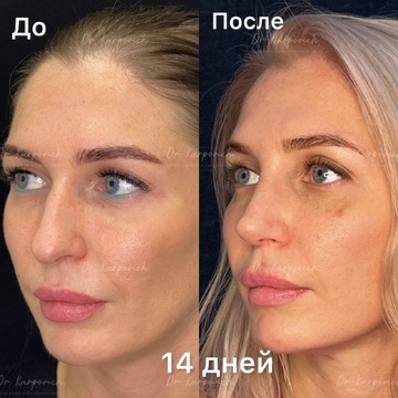 До и после. Ринопластика / риносептопластика. Доктор Сергей Карпович