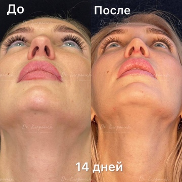 До и после. Ринопластика / риносептопластика. Доктор Сергей Карпович