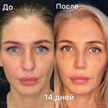 До и после. Ринопластика / риносептопластика. Доктор Сергей Карпович