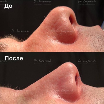 До и после ринопластики. Хирург Сергей Карпович